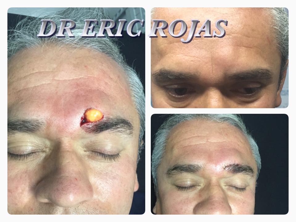 Eliminación de Lipoma en frente sin cicatrices.