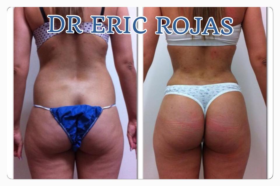 Tus nalgas pueden ser muy diferentes al eliminar tus agarraderas del amor.