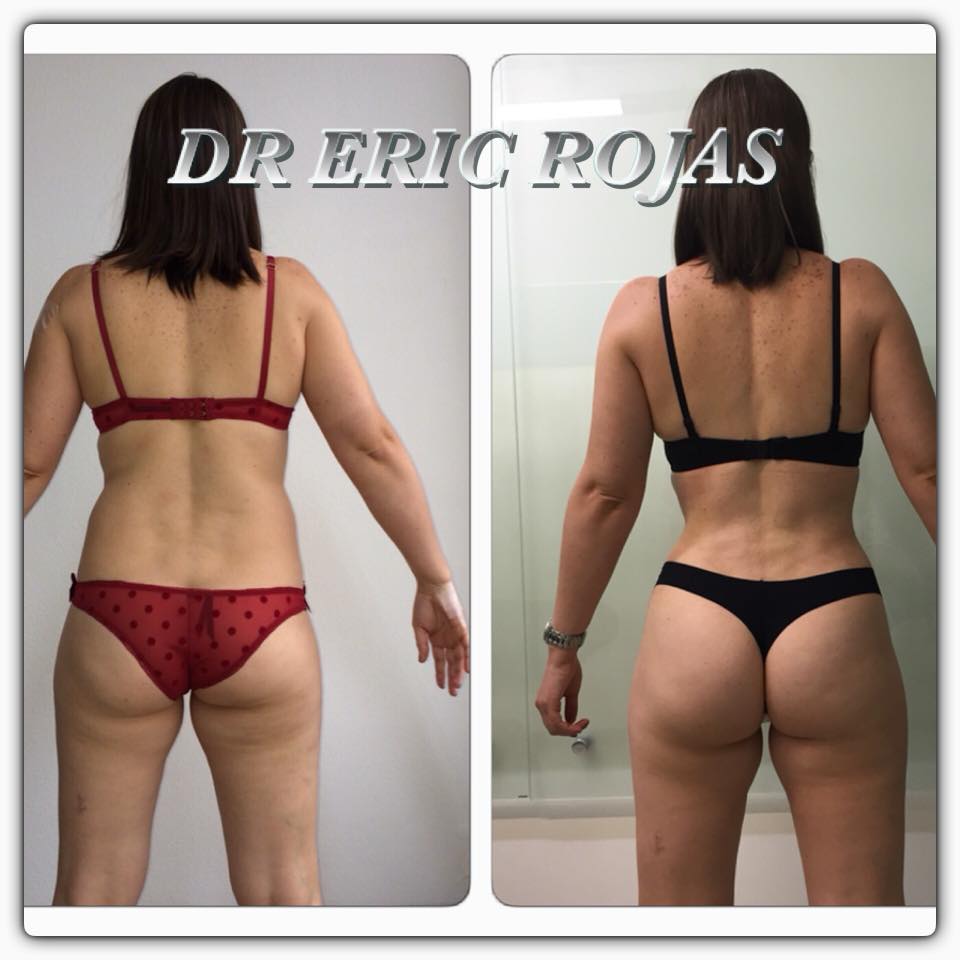 Slim láser cambia tu figura