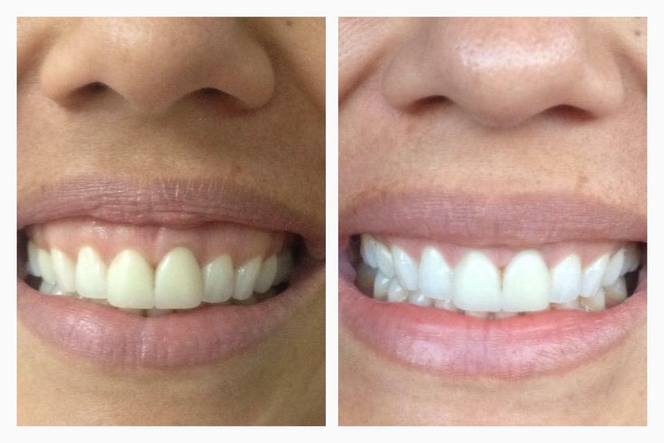 Baja esa sonrisa gingival nosotros lo podemos lograr