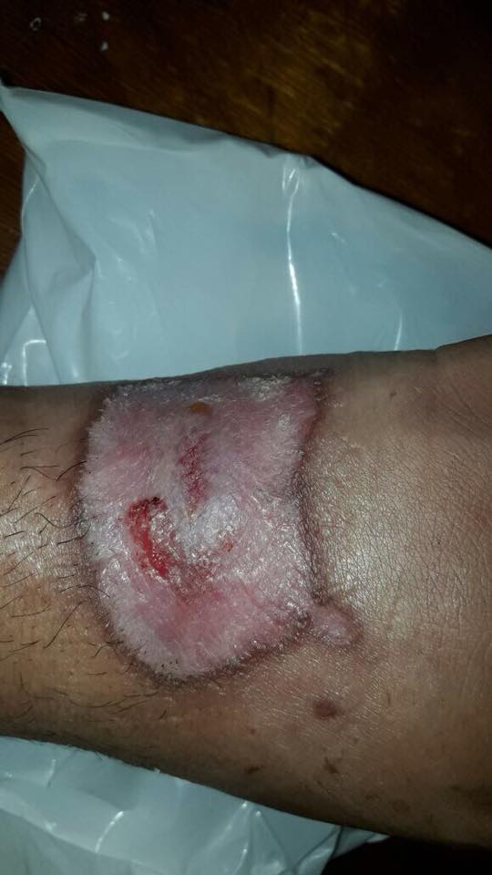 Evolución de úlcera por leishmaniasis