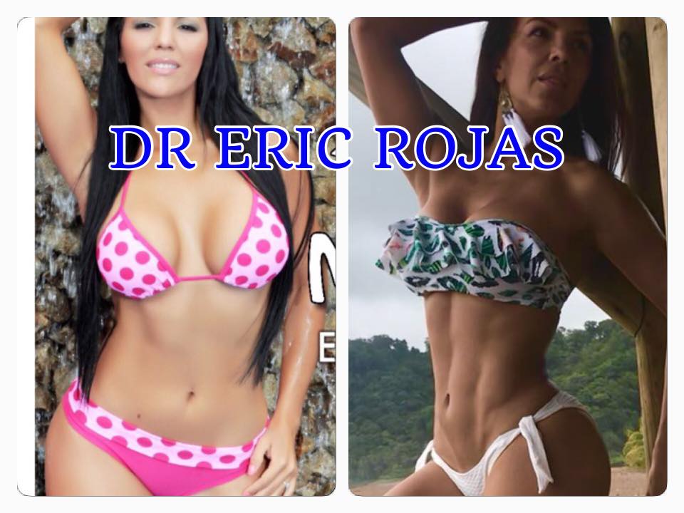 Marcela Negrini antes y después de su marcación abdominal con SLIM LÁSER DR ERIC ROJAS.