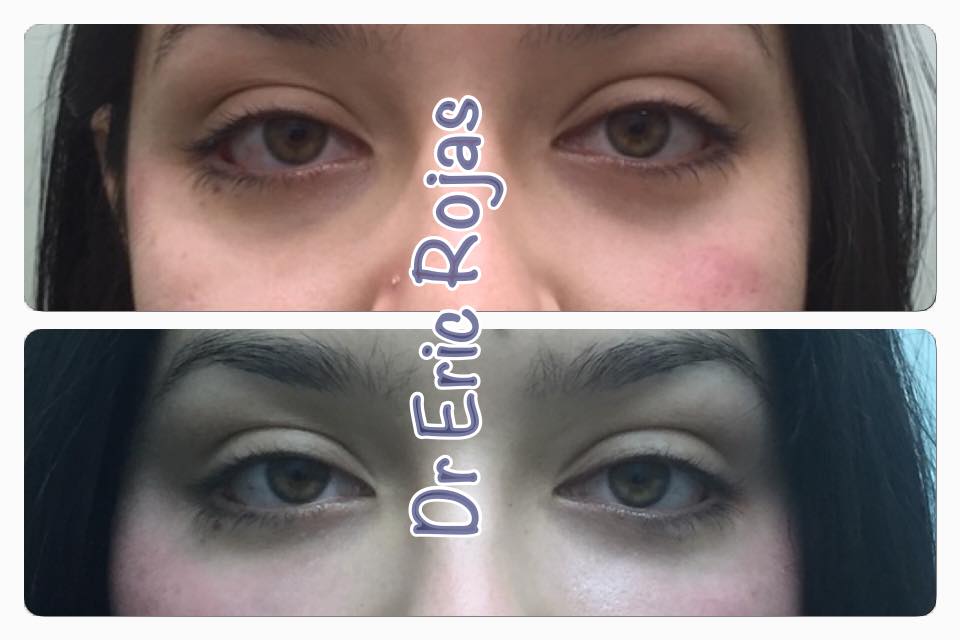 MEJORAR TUS OJERAS