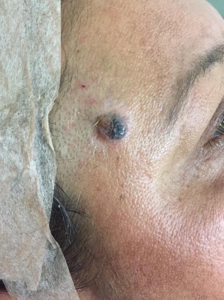 El melanoma maligno es el tumor que se hace de un lunar.