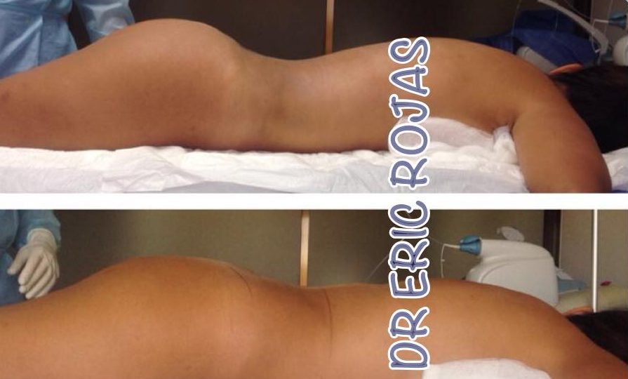 Mejorar tus NALGAS YA ES POSIBLE CON NOSOTROS