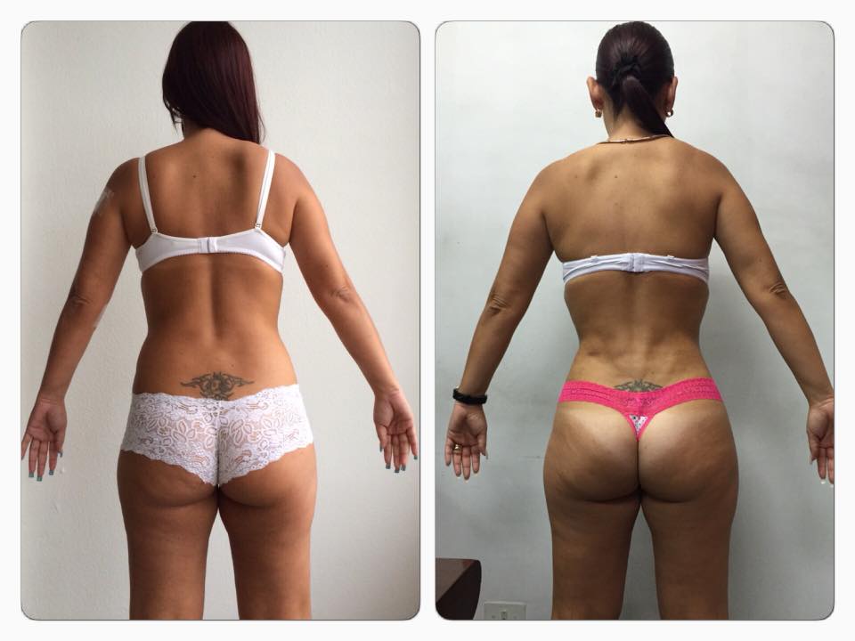 SLIM LÁSER DR ERIC ROJAS ES UNA TÉCNICA LASER PARA MOLDEAR TU FIGURA