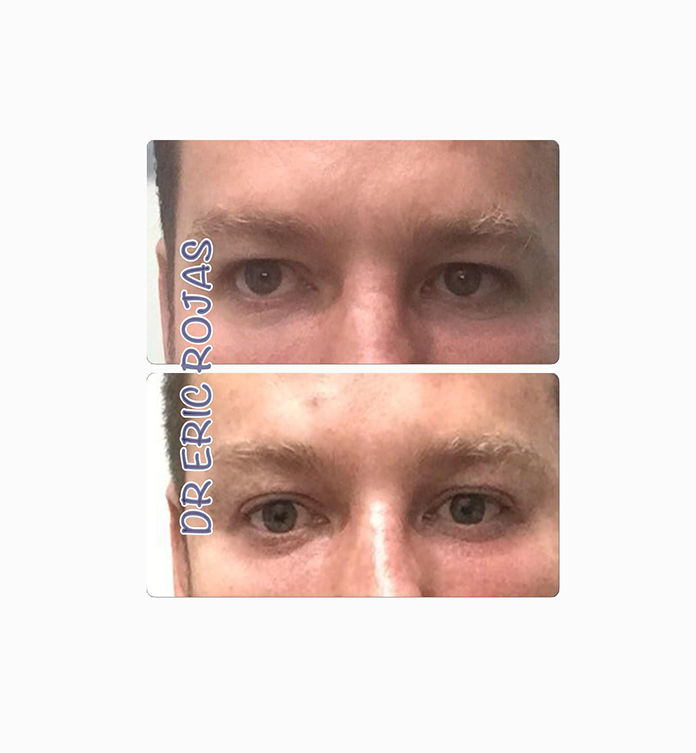 YA PUEDES ABRÍR TUS OJOS SIN CIRUGÍA Y REJUVENECER MUCHIS AÑOS.
