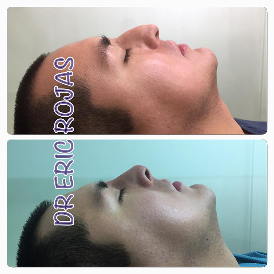 RINO-lift es la nueva invención del DR ERIC ROJAS