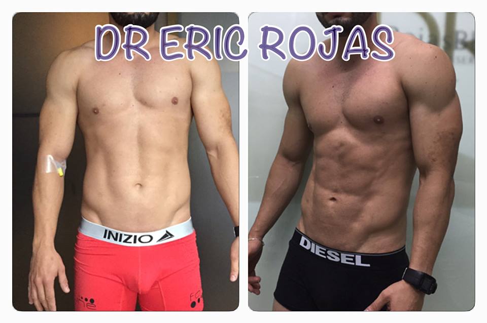 SLIM LÁSER PARA MARCACION ABDOMINAL Y DE BRAZOS