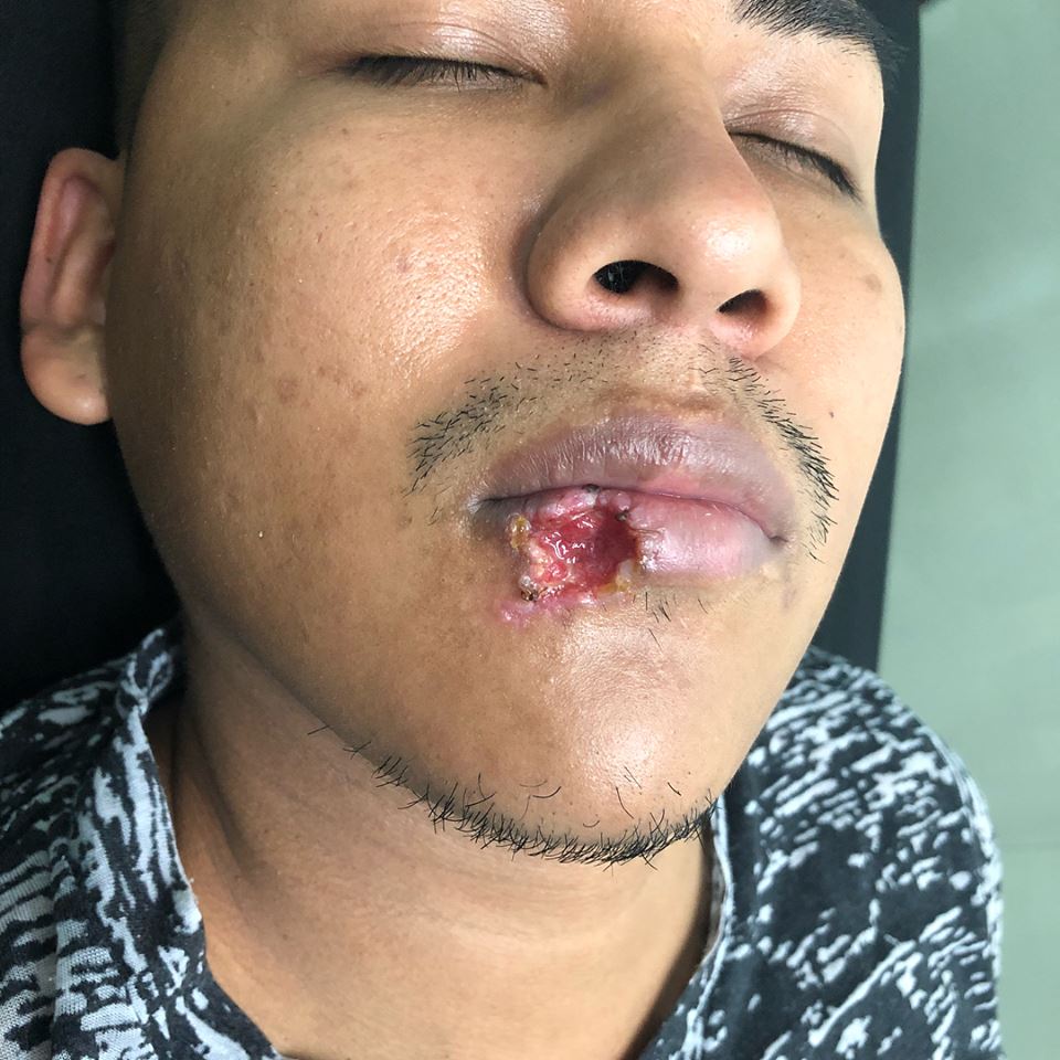 “FOTOS SENSIBLES” TRAUMA CONTRA FILO DE UNA GRADA
