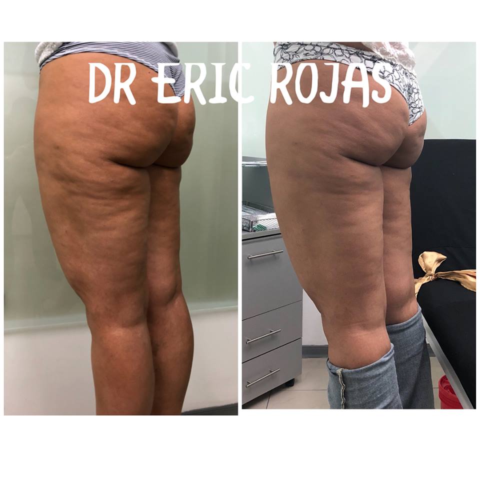 CELULITIS 15 días de TRATAMIENTO