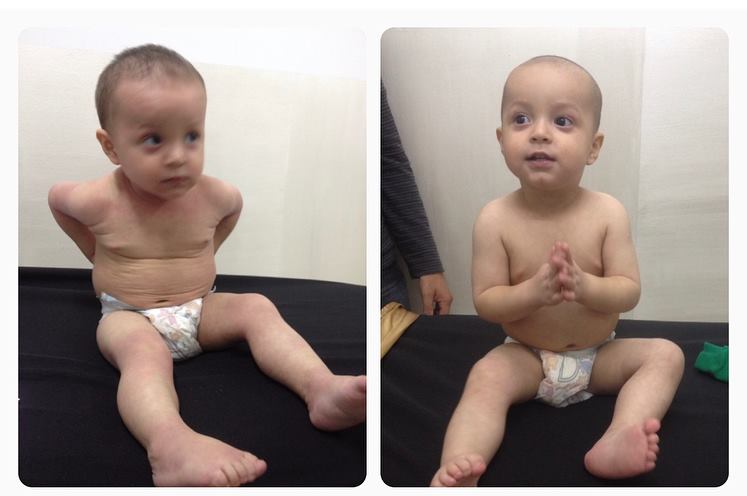 Que alegría ver mis pacientes con DERMATITIS ATOPICA completamente sanos
