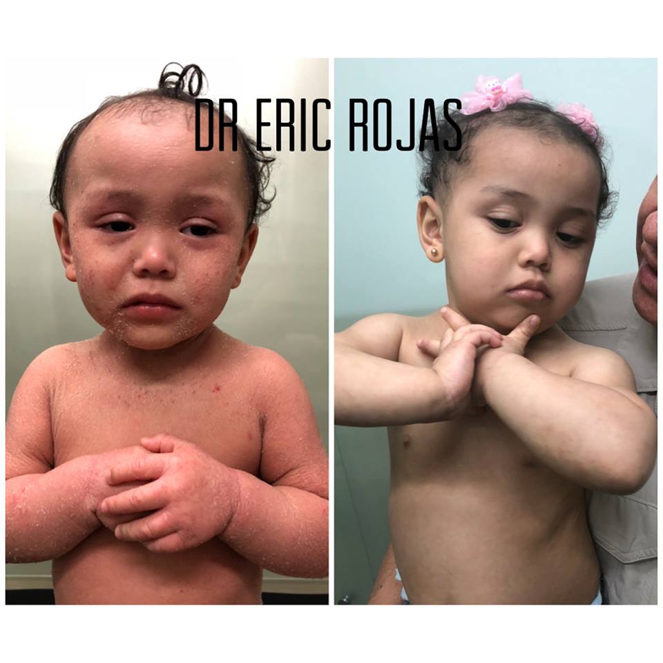 DERMATITIS ATOPICA SEVERA