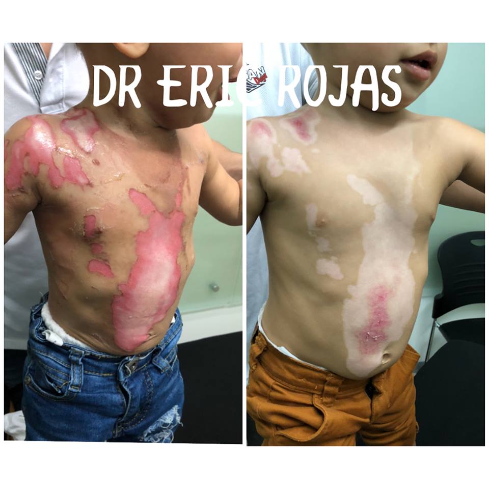 Logramos evitar los daños en los pacientes quemados.
