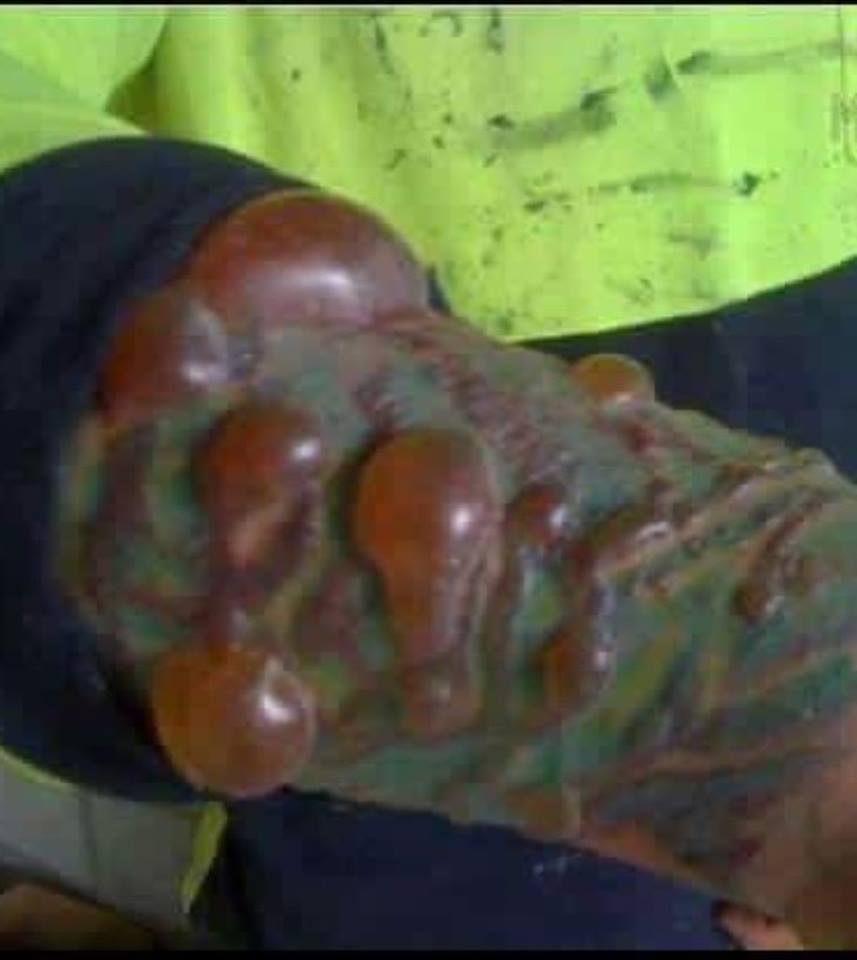 Estas son algunas de las complicaciones que se presentan cuando se realizan tatuajes…