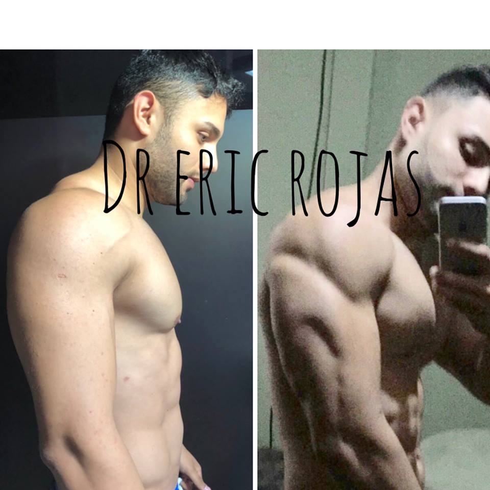 Marcación de BRAZO
