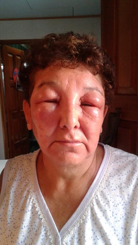 Alergia con angioedema