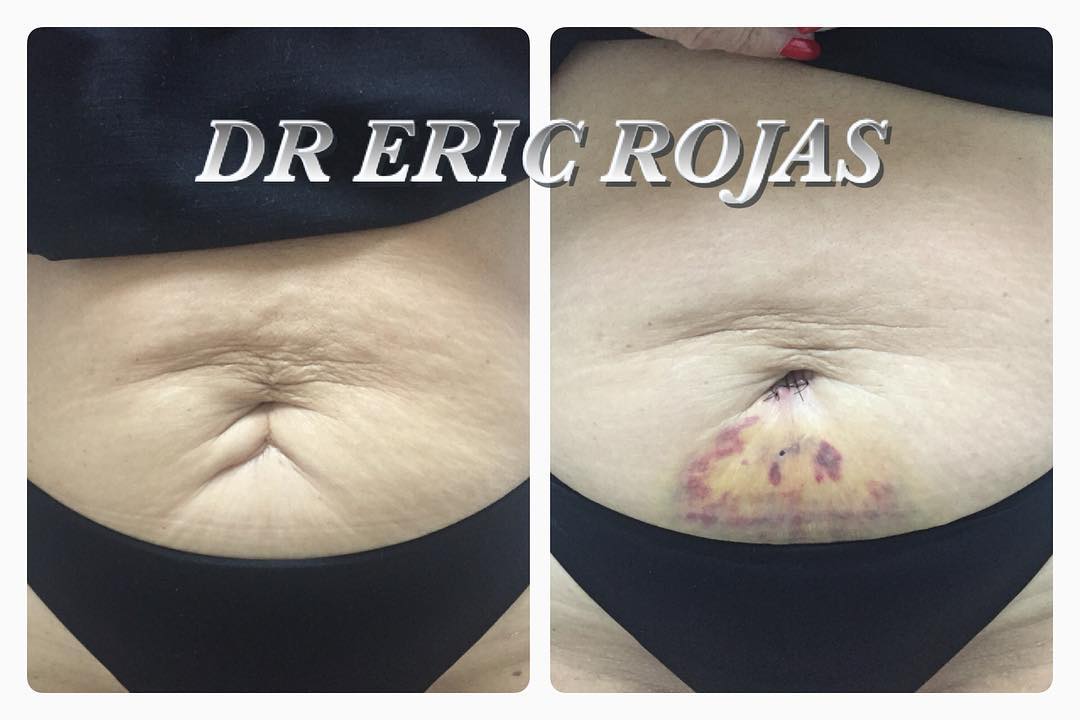 Mejora TUS CICATRICES EN ABDOMEN