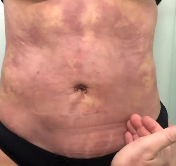 Les muestro el post-operatorio de la paciente