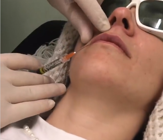 El relleno de labios es simple, rápido e indoloro.