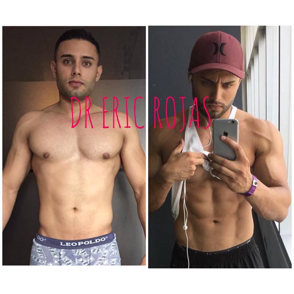 SLIM LÁSER
