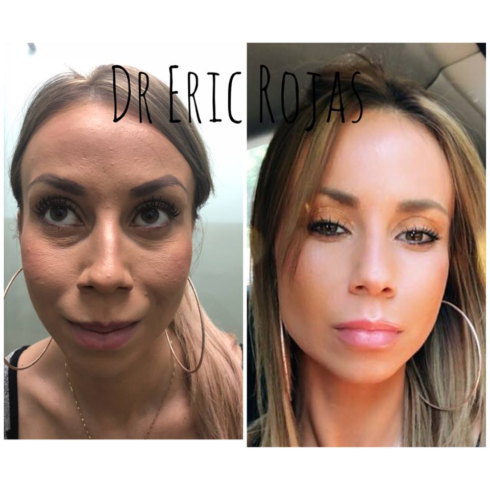 OJERAS , PARPADOS Y REFRESCAMIENTO FACIAL