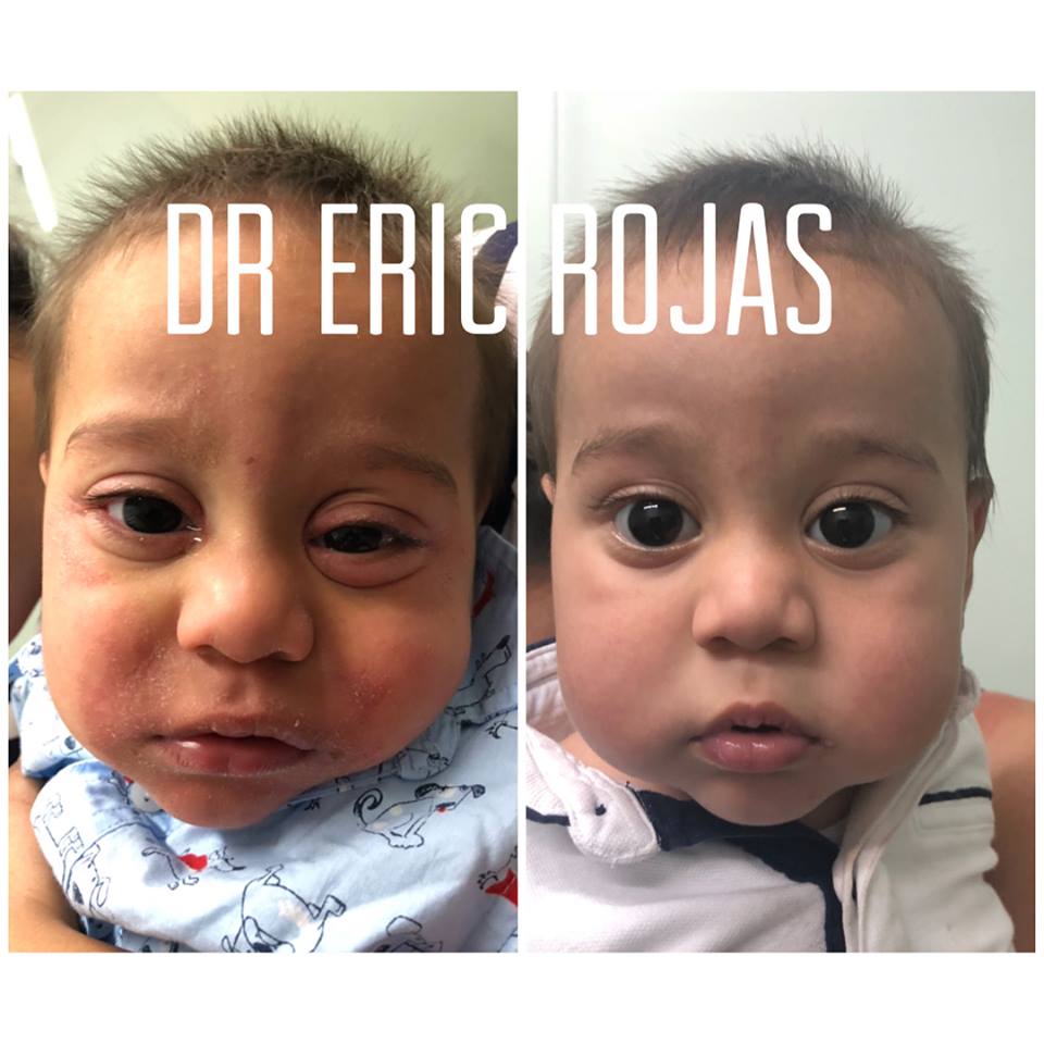 Mejoramos LA PIEL DE TUS HIJOS