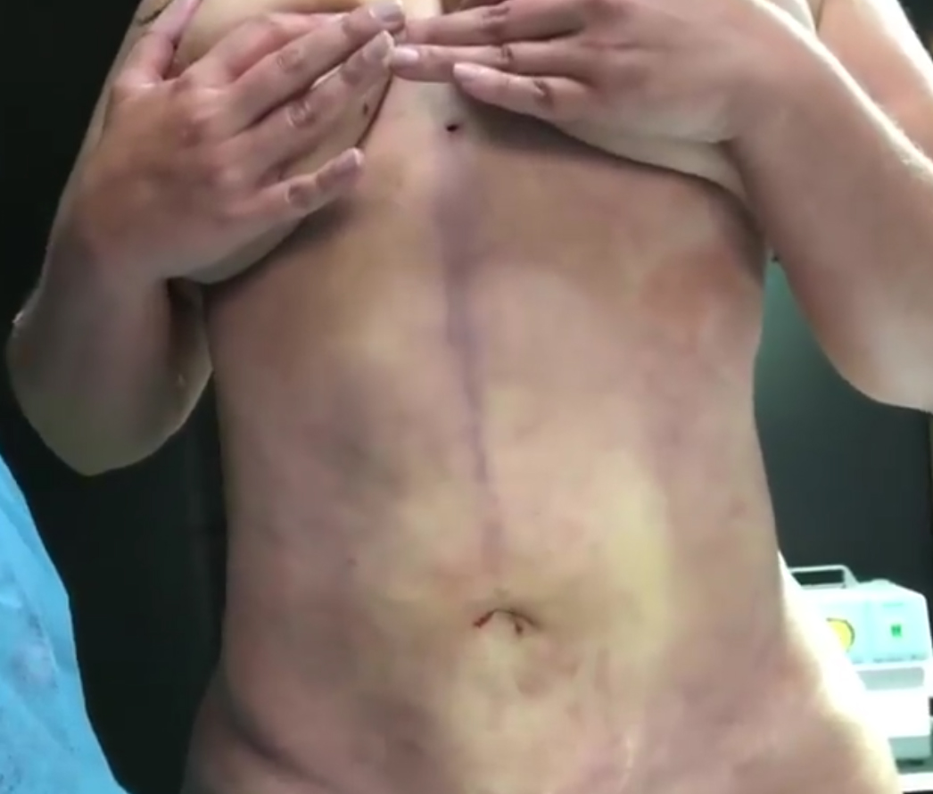 Acabamos de terminar la corrección de abdomen …