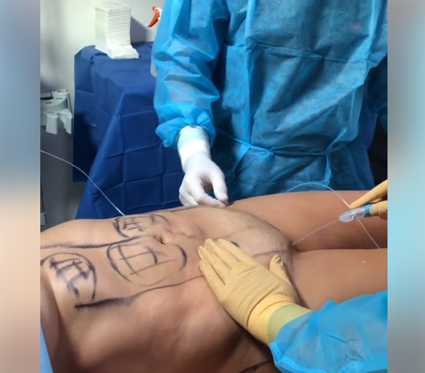 SLIM LASER