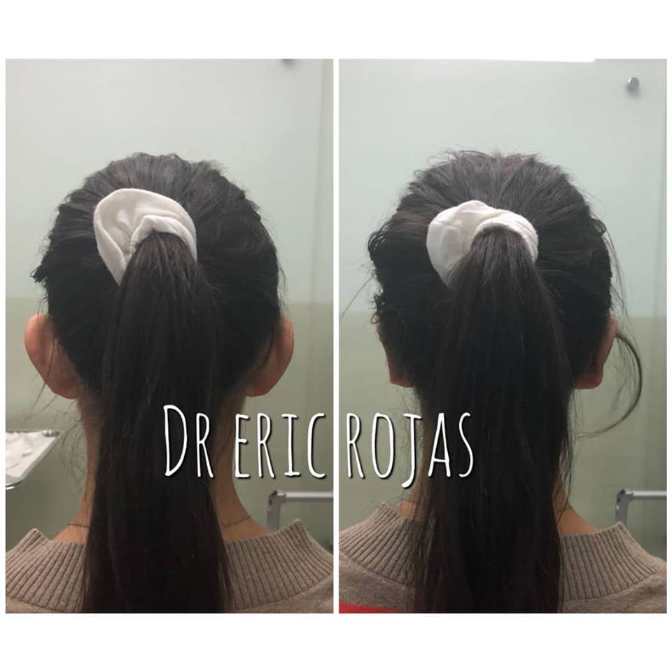La corrección de orejas es posible con el @dr.ericrojas