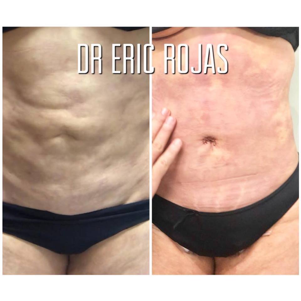 Cirugía de mejorar ombligo y fibrosis de otra cirugía anterior