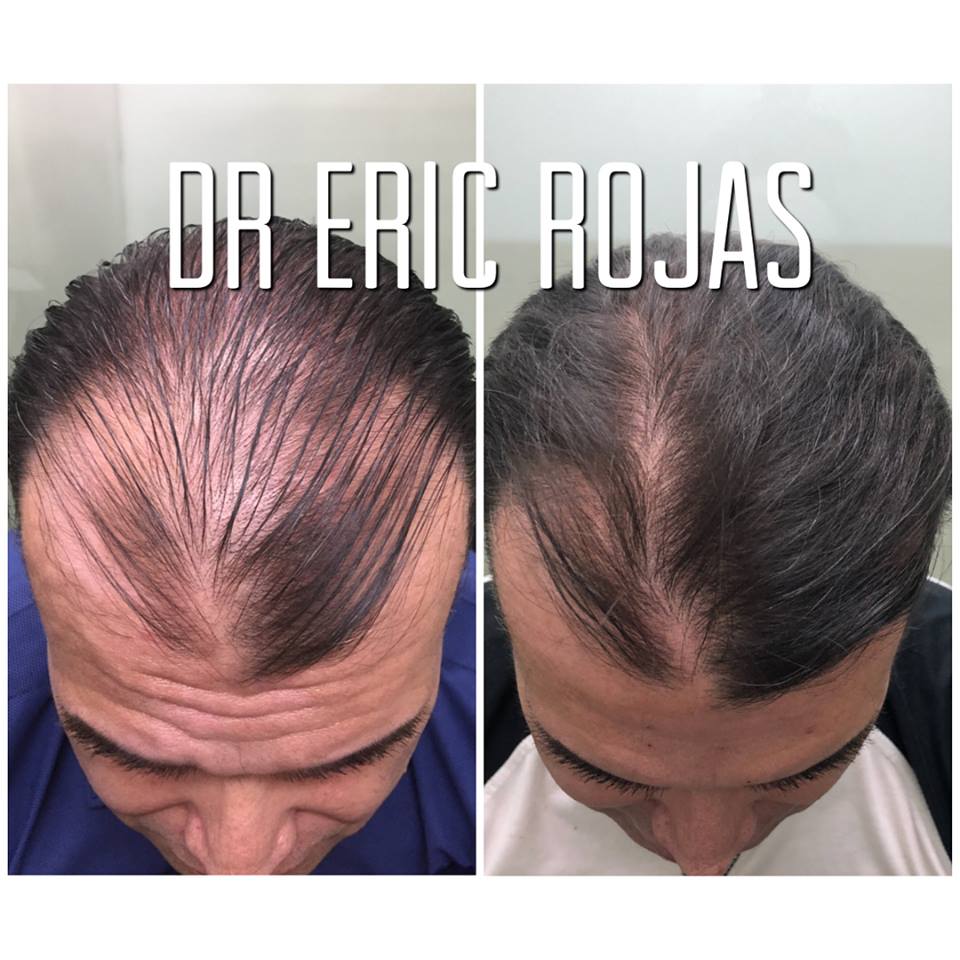 PELO NO LO PIERDAS