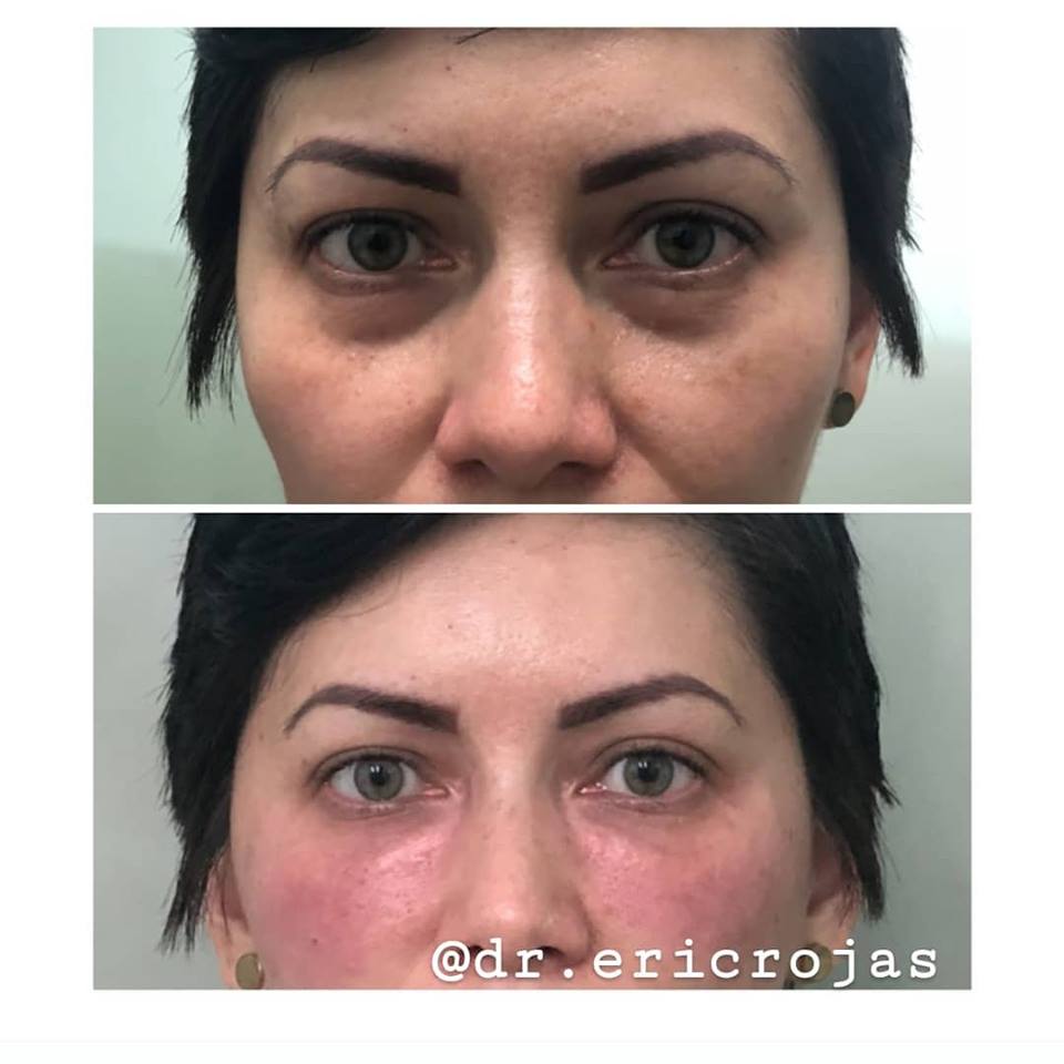 Elimine sus ojeras con el @dr.ericrojas