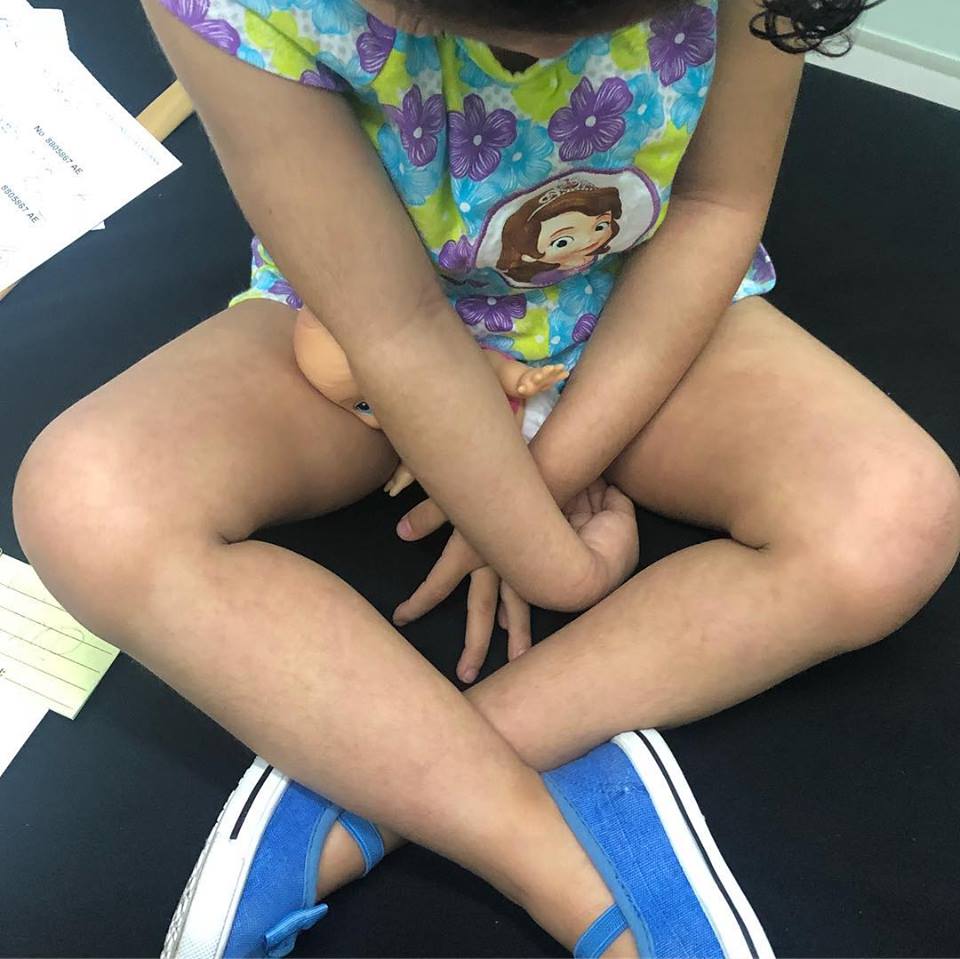 Dermatitis ATÓPICA SEVERA