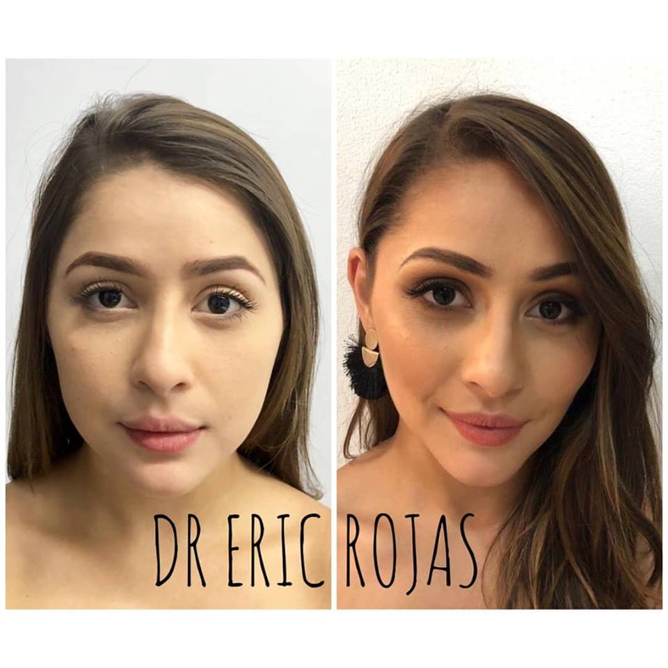 Perfilado facial