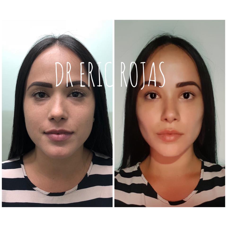 Perfilado FACIAL CON SLIM LÁSER DEL DR ERIC ROJAS 22483535