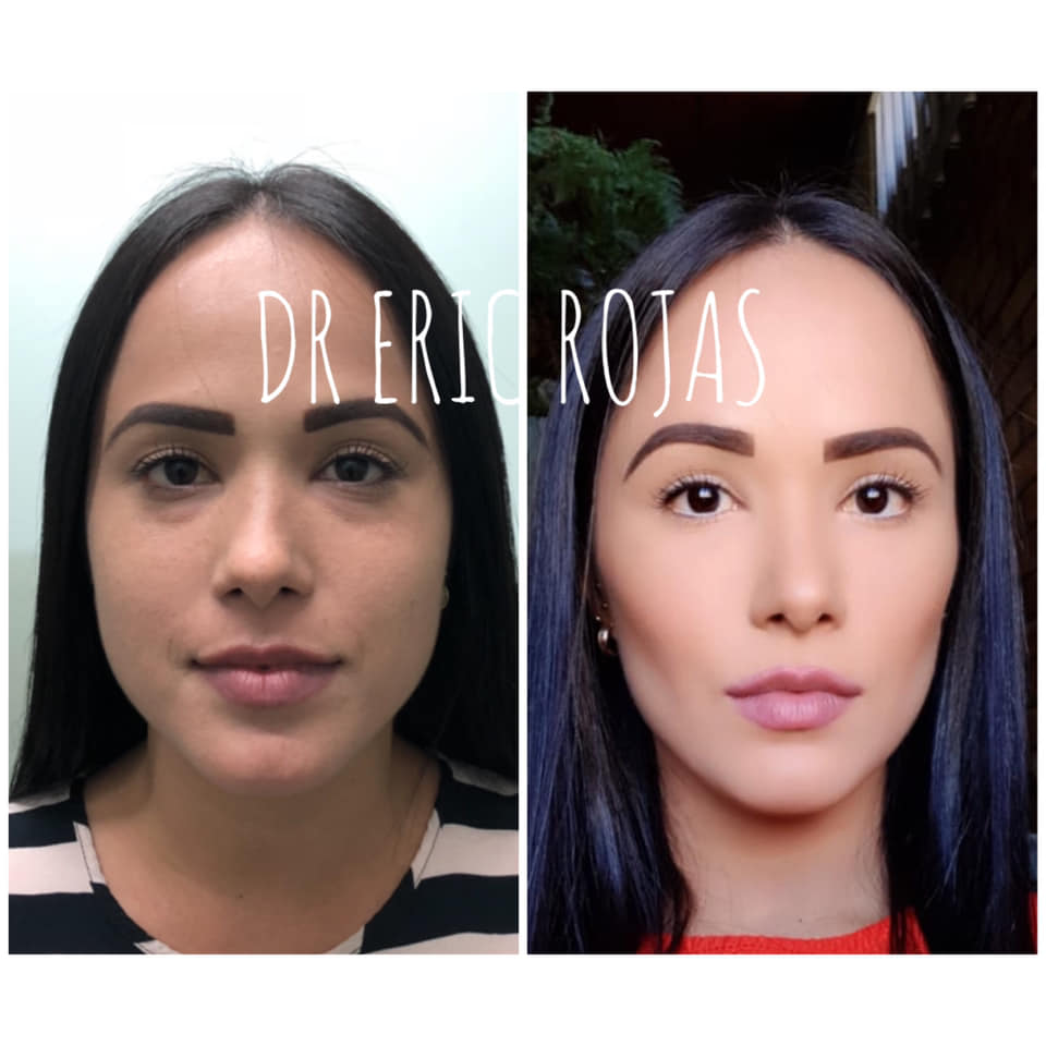 Perfilado facial SLIM
