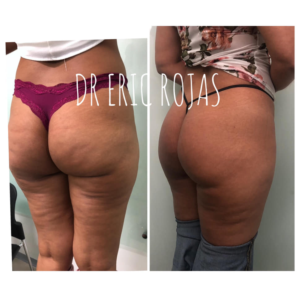 Celulitis nosotros la mejoramos