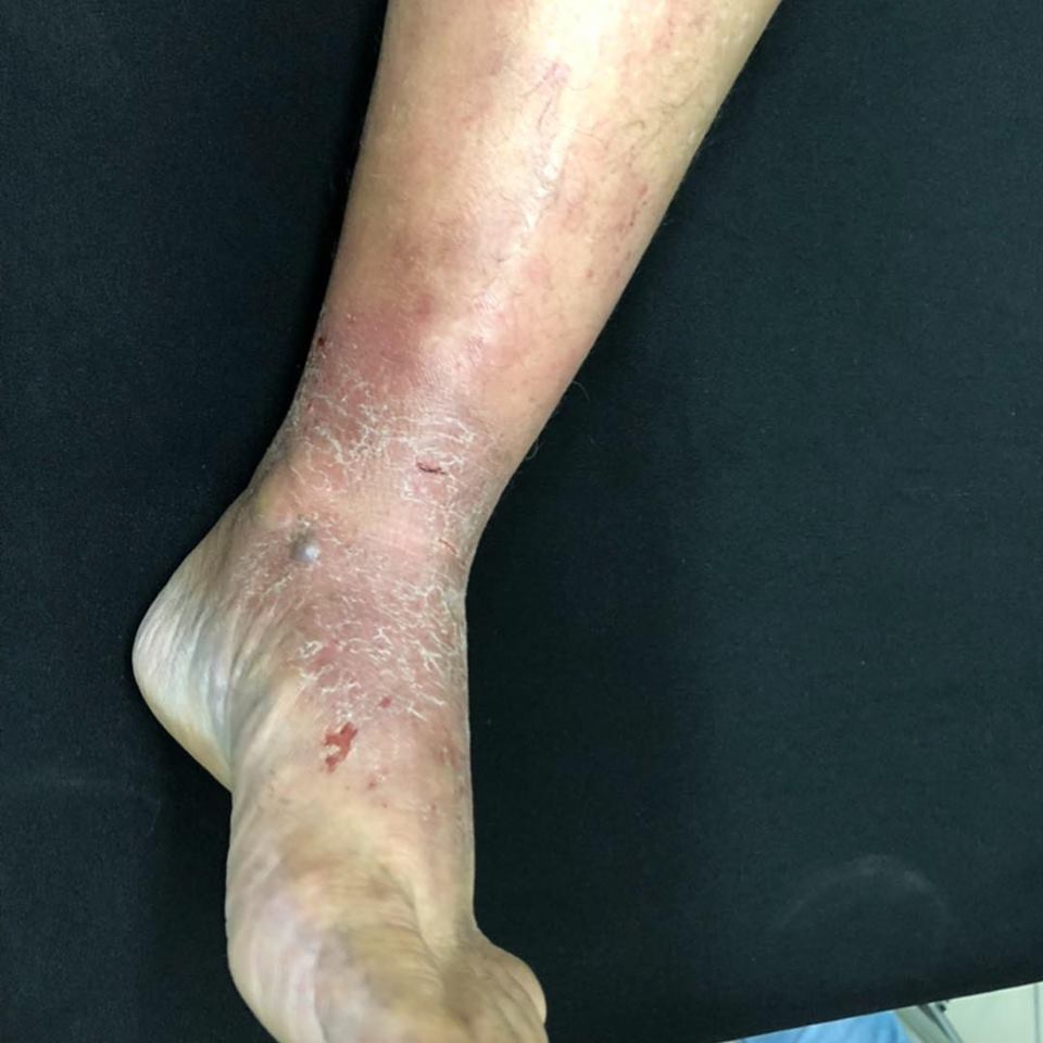 Celulitis más engrosamiento