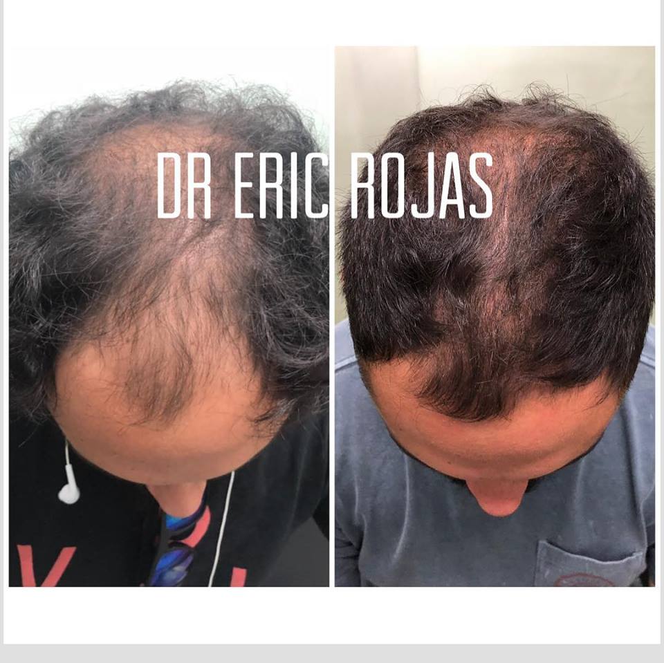 Caída de CABELLO YA NO MÁS