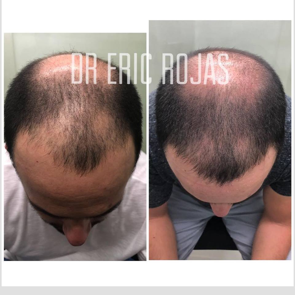 2 meses de tratamiento