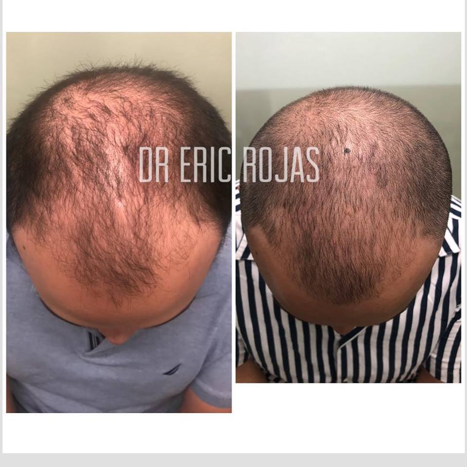 1 mes de tratamiento