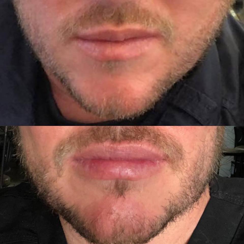 No solo las mujeres mejoran sus labios