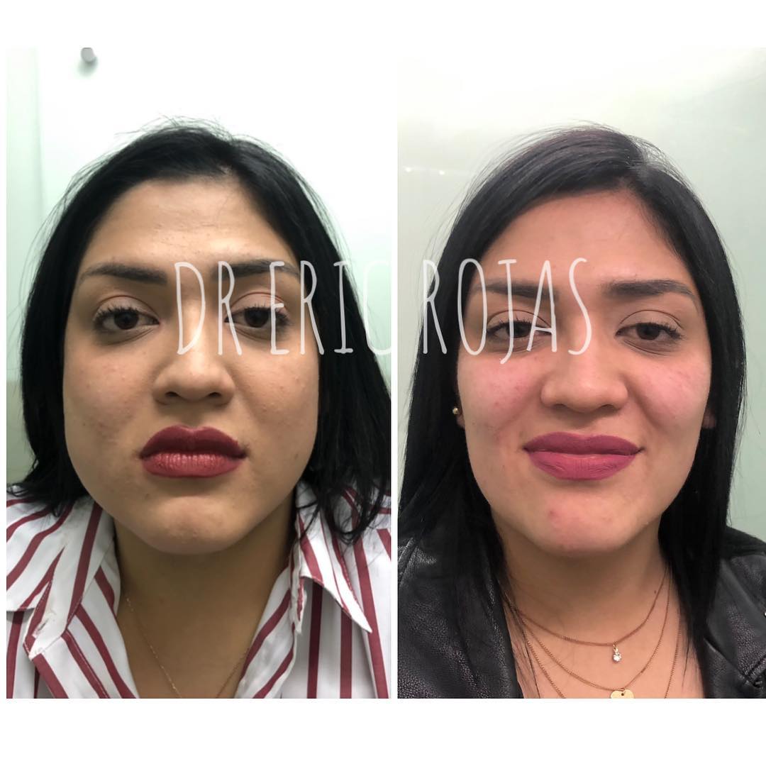 PERFILADO FACIAL SLIM LÁSER