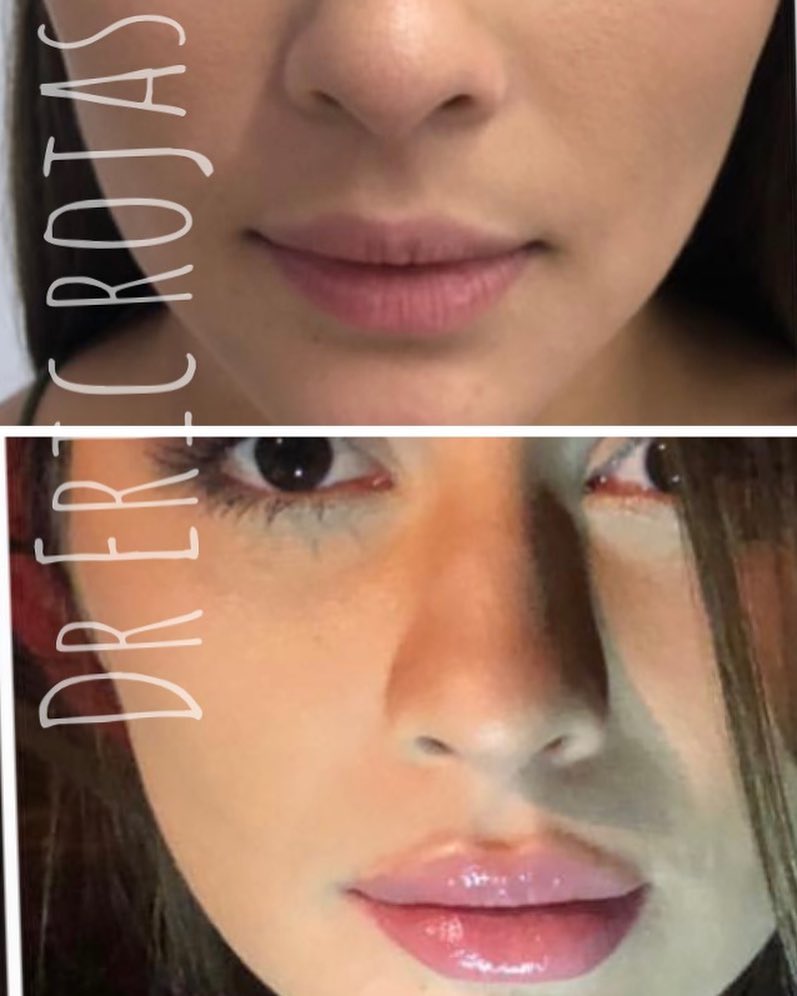 Dale volumen a tus labios y dejémoslos perfectos