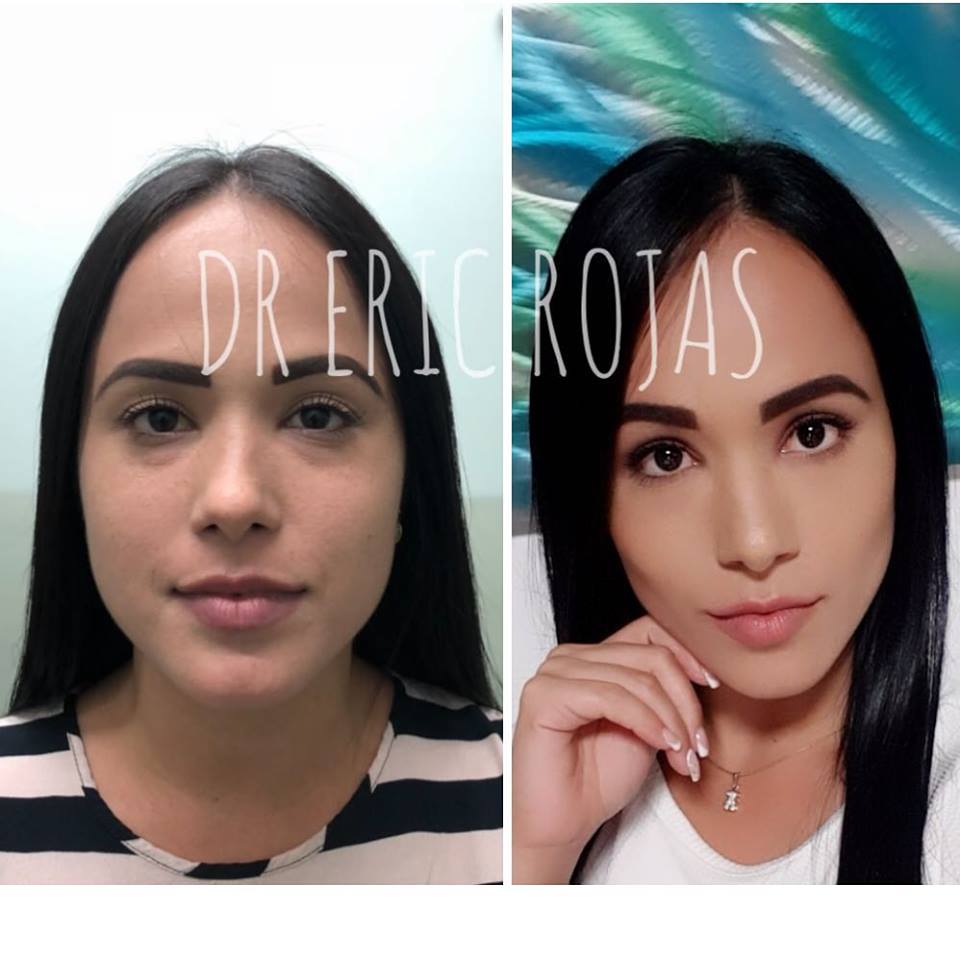 PERDILADO FACIAL