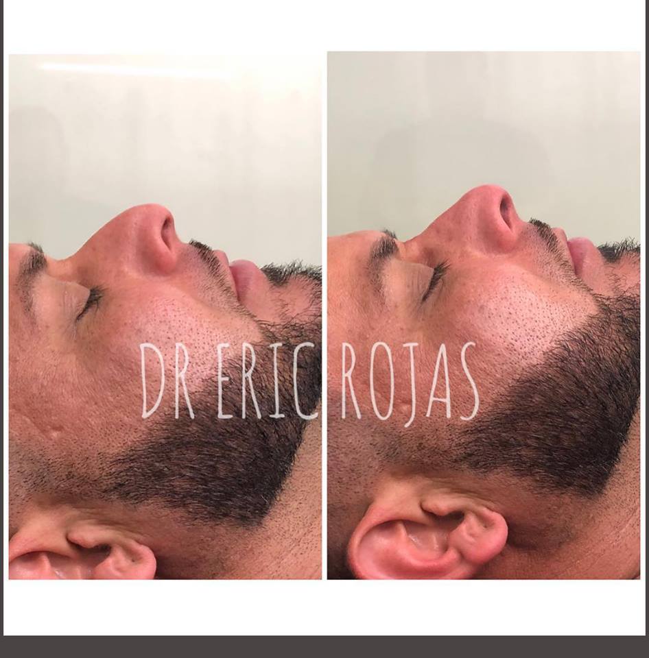 NARIZ SIN CIRUGÍA