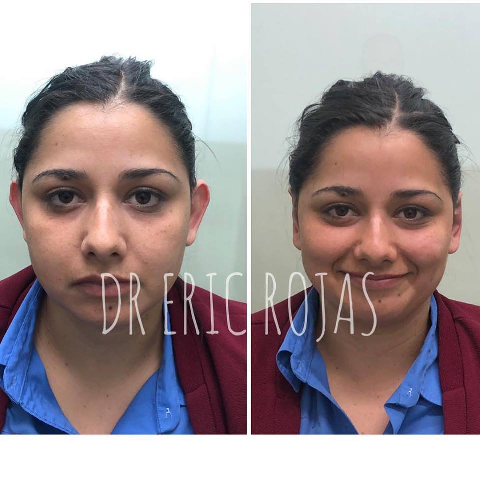 En menos de 20 minutos y con anestesia local