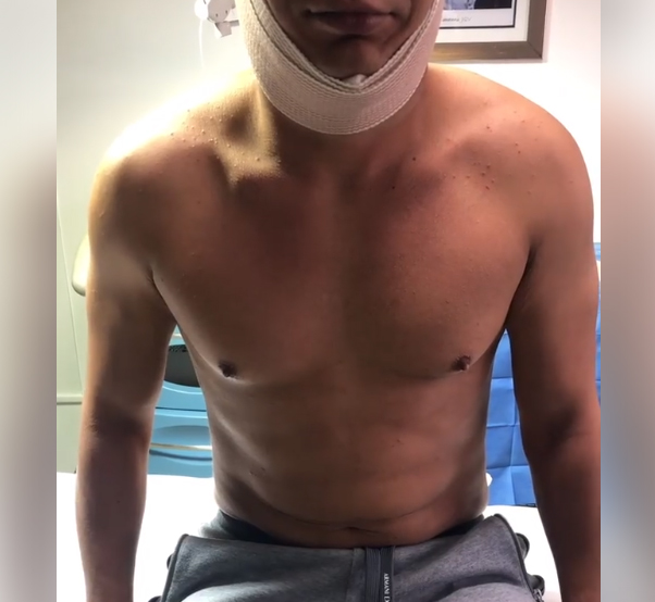 Papada recién terminada con SLIM LÁSER 