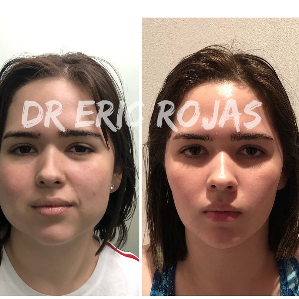Perfilado FACIAL LÁSER